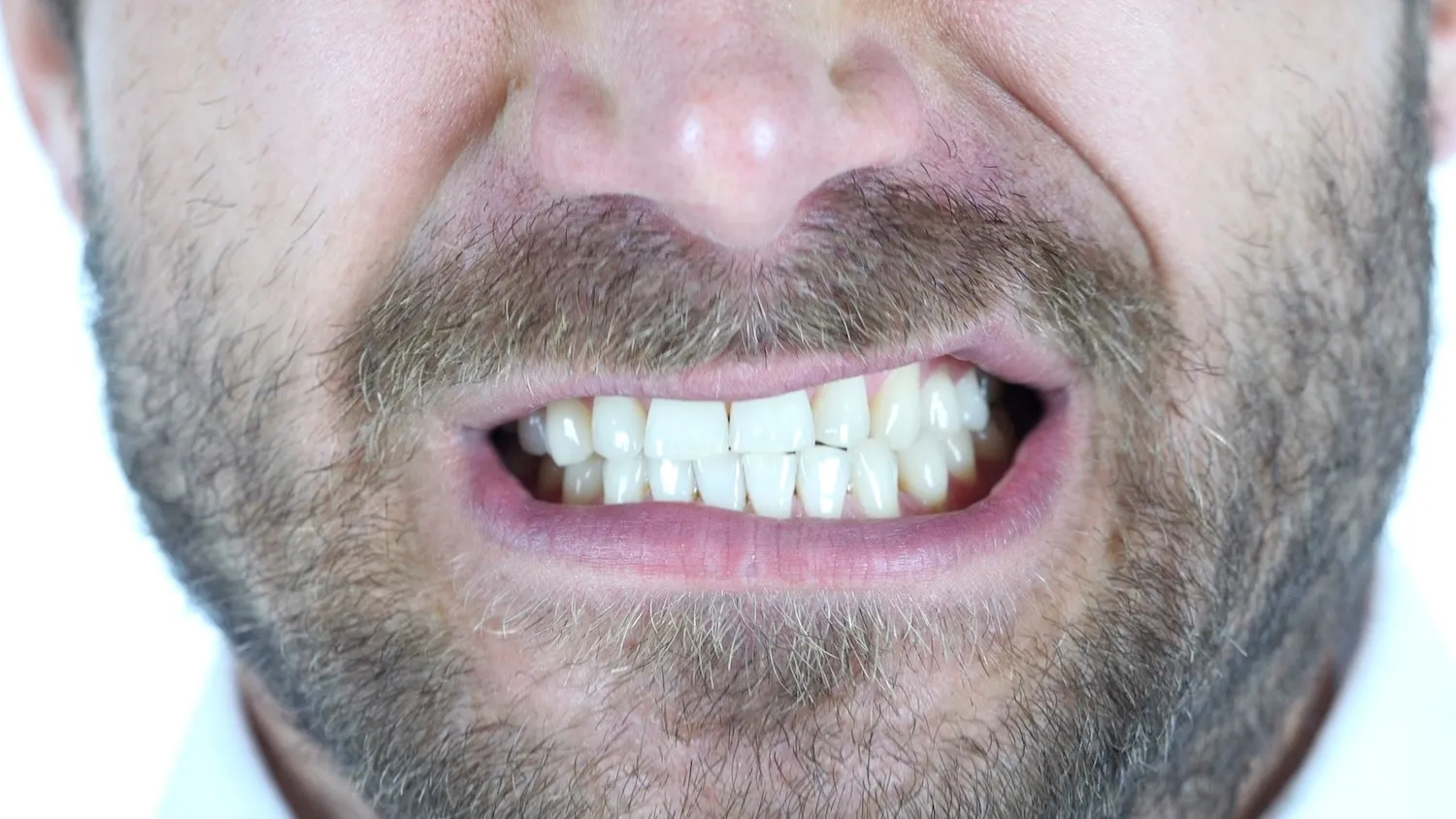 What is bruxism and how can it be treated?